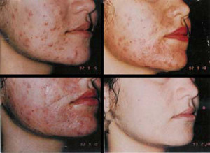chemical-peel-acne-treatments_1_5164
