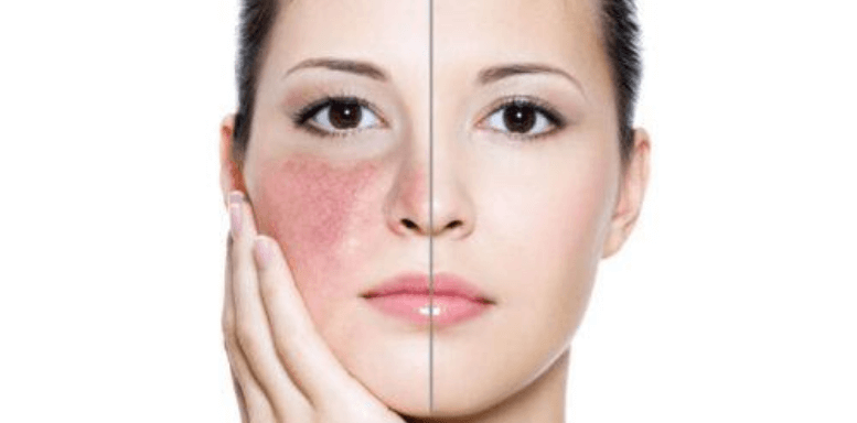 Механизмы развития повышенной чувствительности кожи