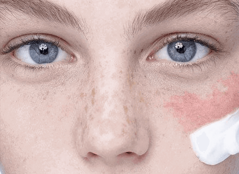 Причины возникновения аллергии на коже