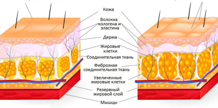 Стадии целлюлита фото как