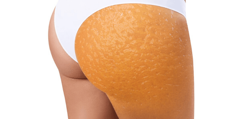 Целлюлит определение, стадии, апельсиновая корка на теле