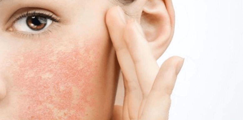 Причины возникновения аллергии на коже лица