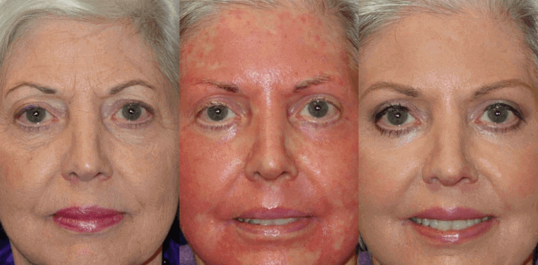 этапы восстановления кожи после химического пилинга